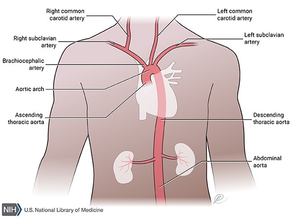 Aneurysm of Aorta Could be Fatal - Aortic Aneurysm and High Blood Pressure