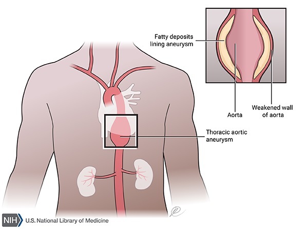 aortic-aneurysms-what-my-patients-need-to-know-about-abdominal-aortic